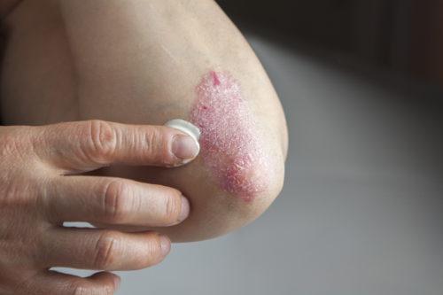 Eczema Seborrheic Dermatitis Psoriasis Managing The Itch Pharmaceutical Specialties Inc